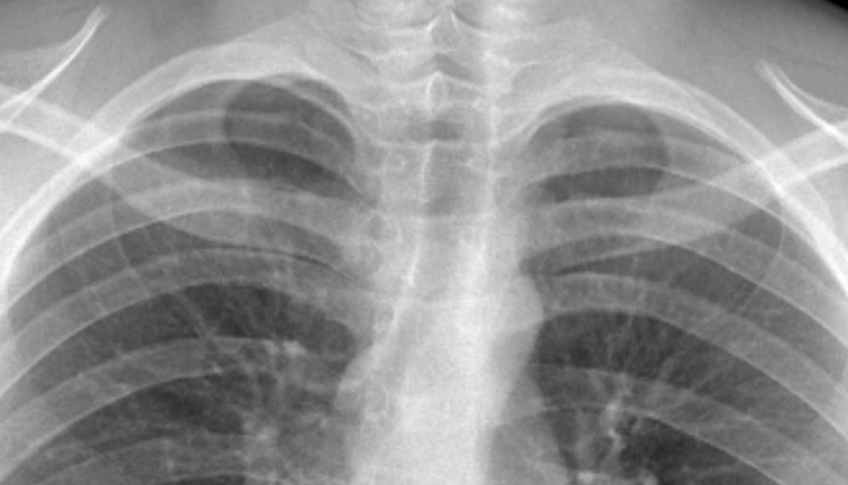 Salvan a un joven tinogasteño tras un grave trauma de tórax con un objeto metálico